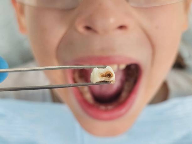 Best Dentist for Tooth Abscess  in Milan, TN